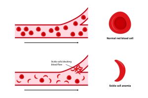 diagram of sickle cell anemia