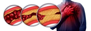 Heart attack disease pain as an anatomy medical disease concept with a person suffering from a cardiac illness as a painful coronary event due to clogged arteries or arterial plaque with 3D illustration elements.