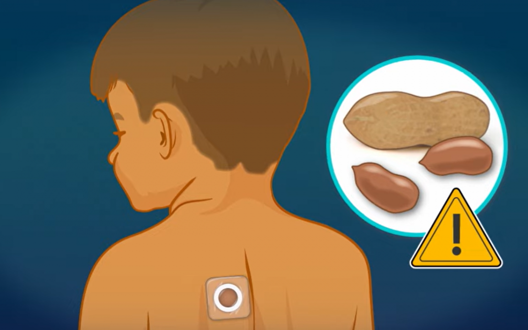 Friday Feature:  Experimental Peanut Patch Therapy for Toddlers with Peanut Allergy