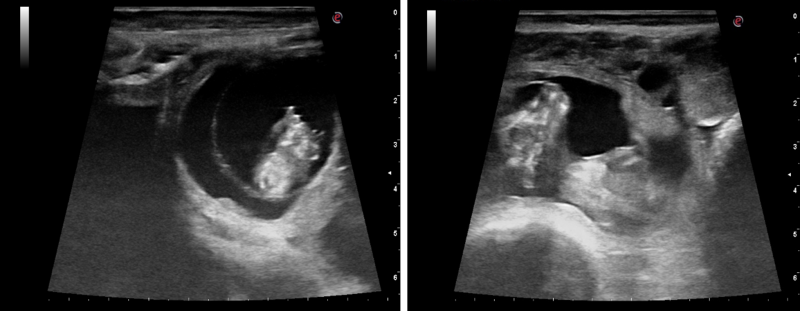 Ultrasound pregnancy image